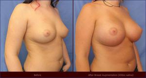 boob augmentation before and after