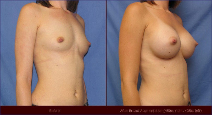 Breast Augmentation Before And After Porn