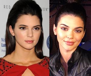 kendall jenner plastic surgery before and after