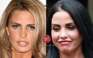 celebrity botox before and after