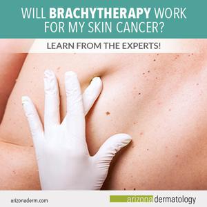 brachytherapy for skin cancer photos after