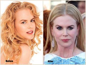 nicole kidman plastic surgery in advance of after