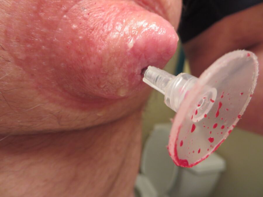 Needle Insertion Into Nipples