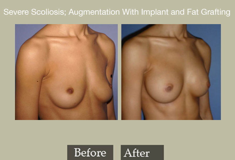 Fat Transfer Breast Before And After