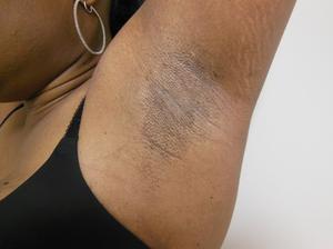 titty implant underarm scars