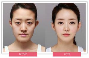 korean plastic surgery previous to after
