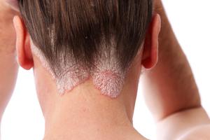 natural remedies for scalp psoriasis