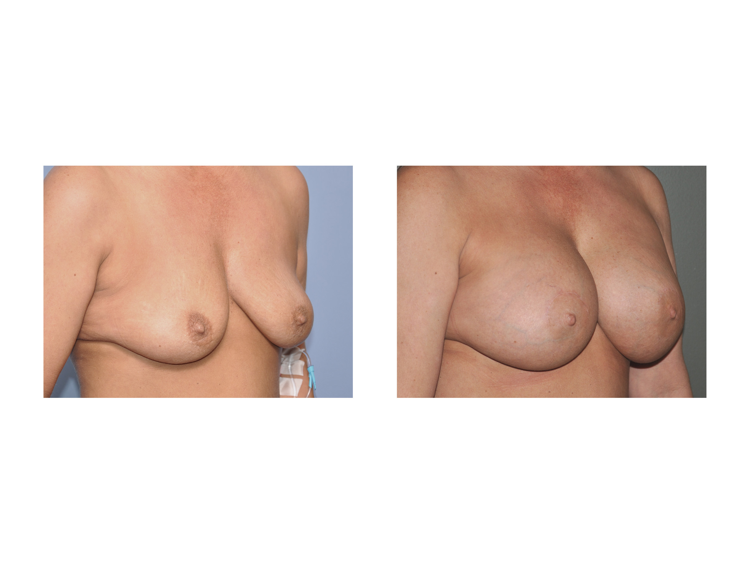 Small Nipples Breast Augmentation